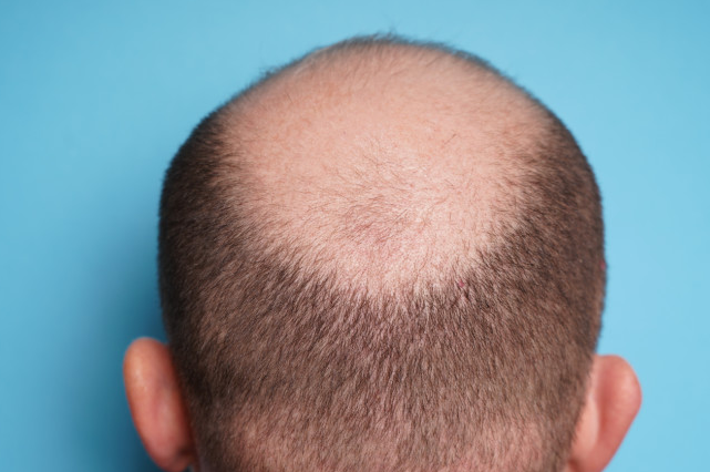 Can BCAA Cause Hair Loss.png